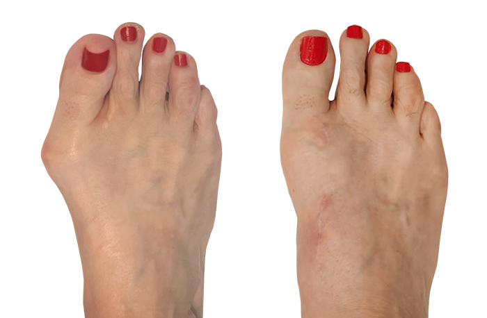 Side by side images of a patient's foot with bright red nail polish, showing the appearance before and after Lapiplasty 3D bunion correction. Image courtesy of Marque A. Allen, DPM