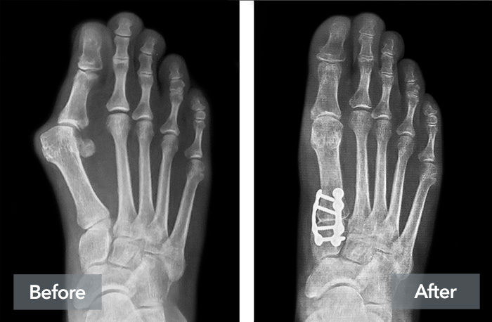 Side by X-Ray side images of a patient's foot, showing the appearance before and after Lapiplasty 3D bunion correction for a bunion.