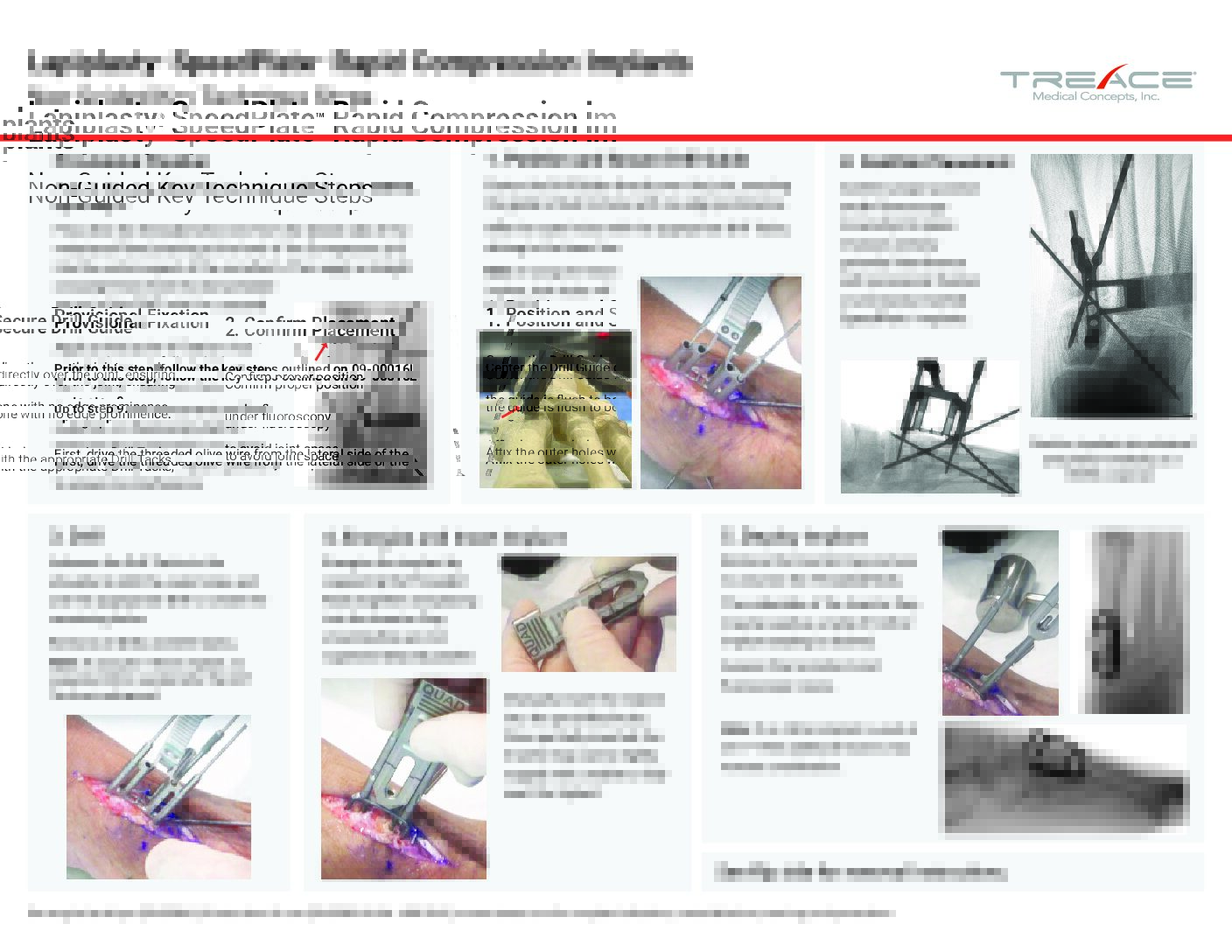 SpeedPlate™ Rapid Compression Implants Key Steps