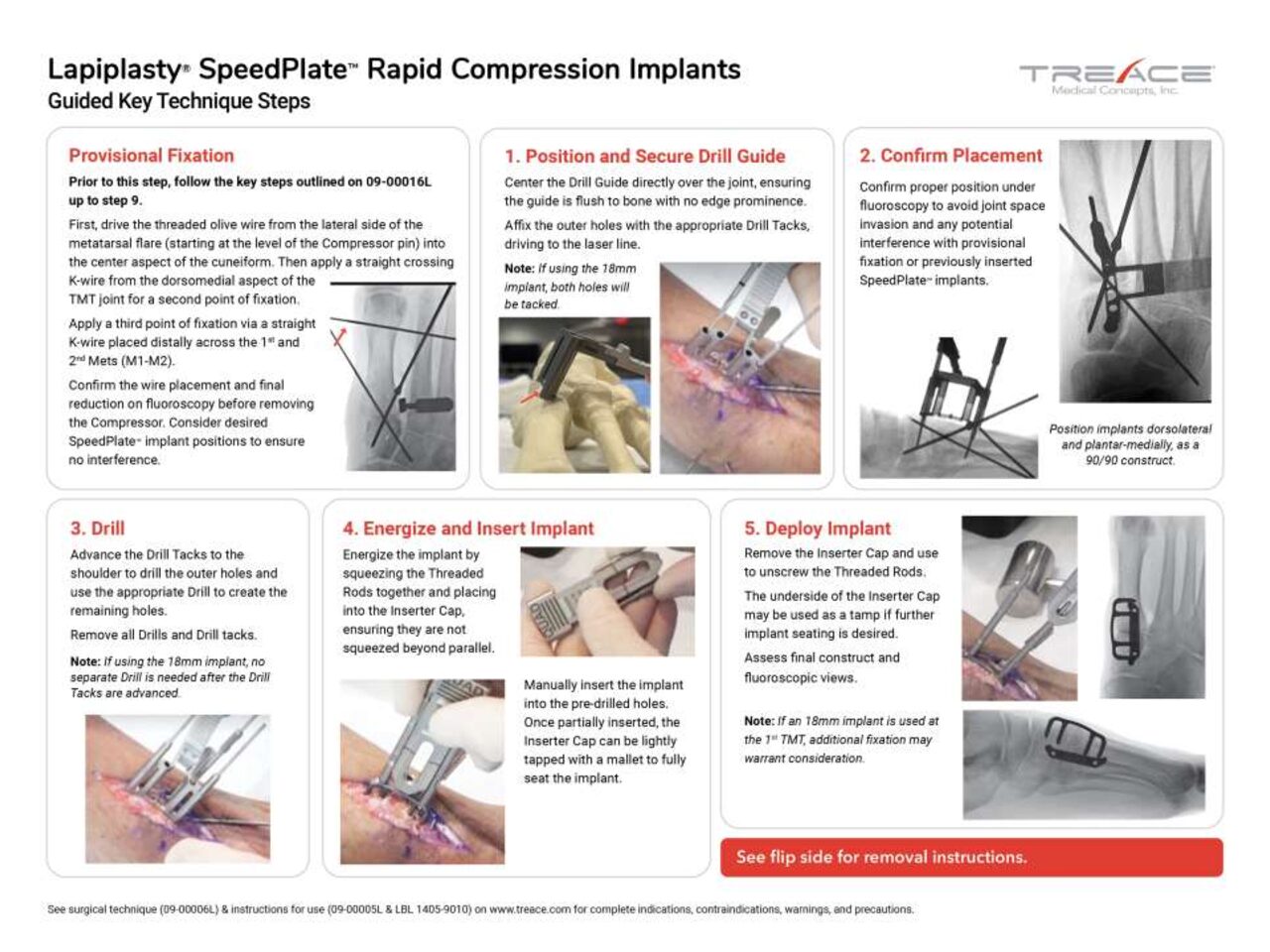 SpeedPlate™ Rapid Compression Implants Key Steps