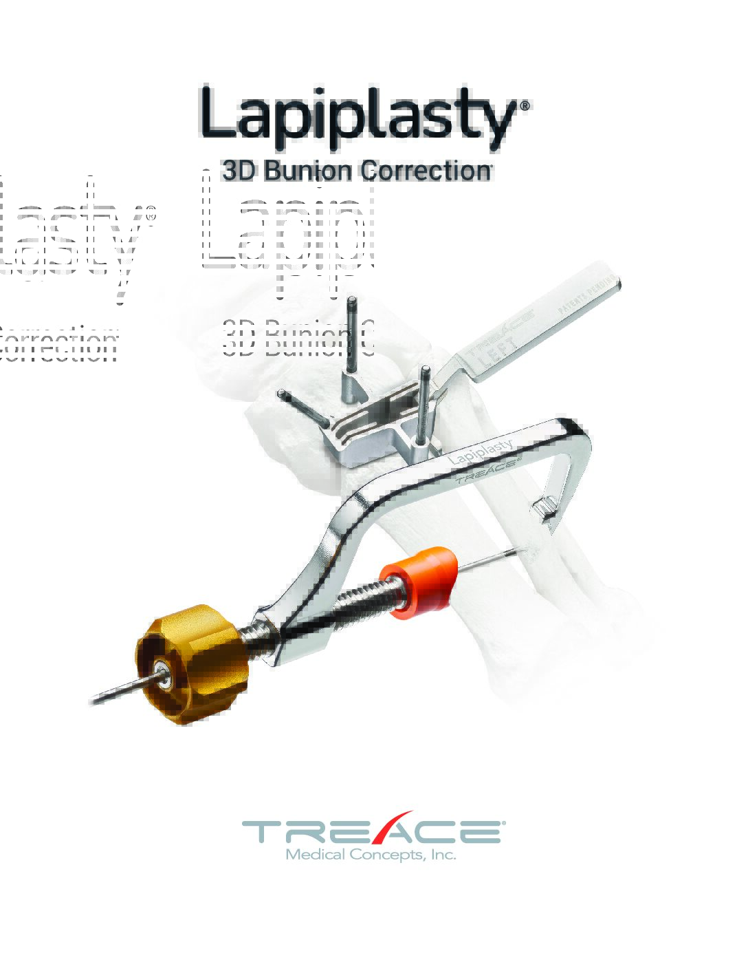 Lapiplasty® Brochure
