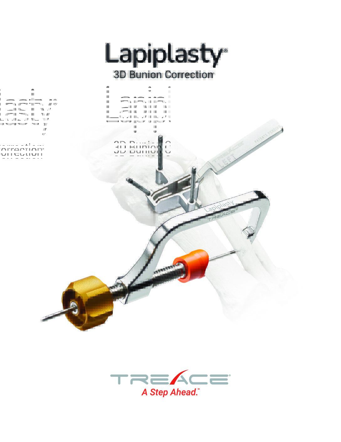 Lapiplasty® Brochure