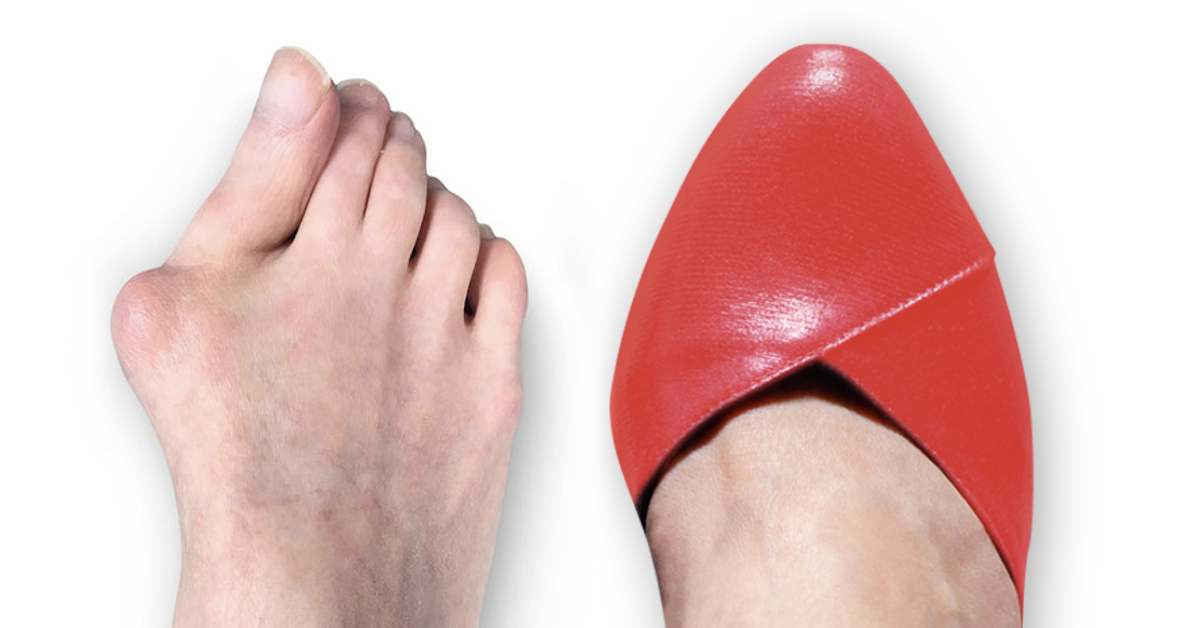 About Bunions Treace Medical Concepts, Inc.