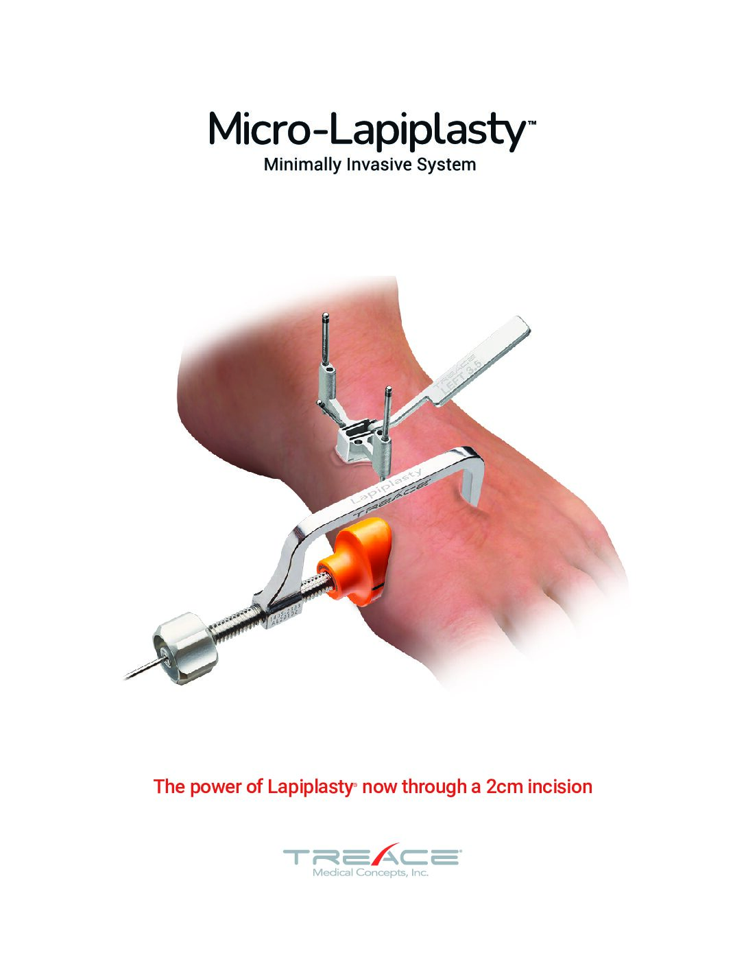Micro-Lapiplasty™ Sales Sheet