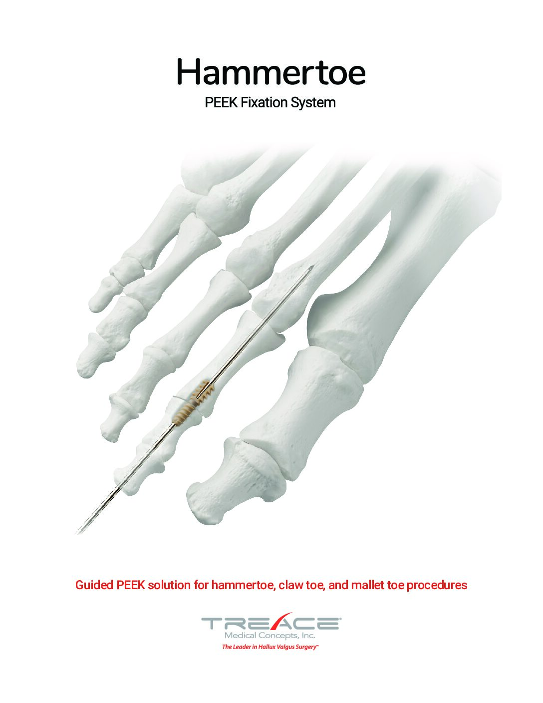 Hammertoe Sales Sheet