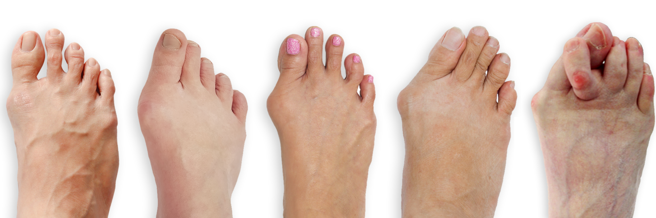 When Should I Get Bunion Surgery? Treace
