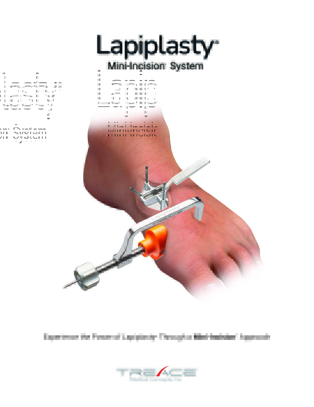 Lapiplasty® Mini-Incision™<br/> System Brochure