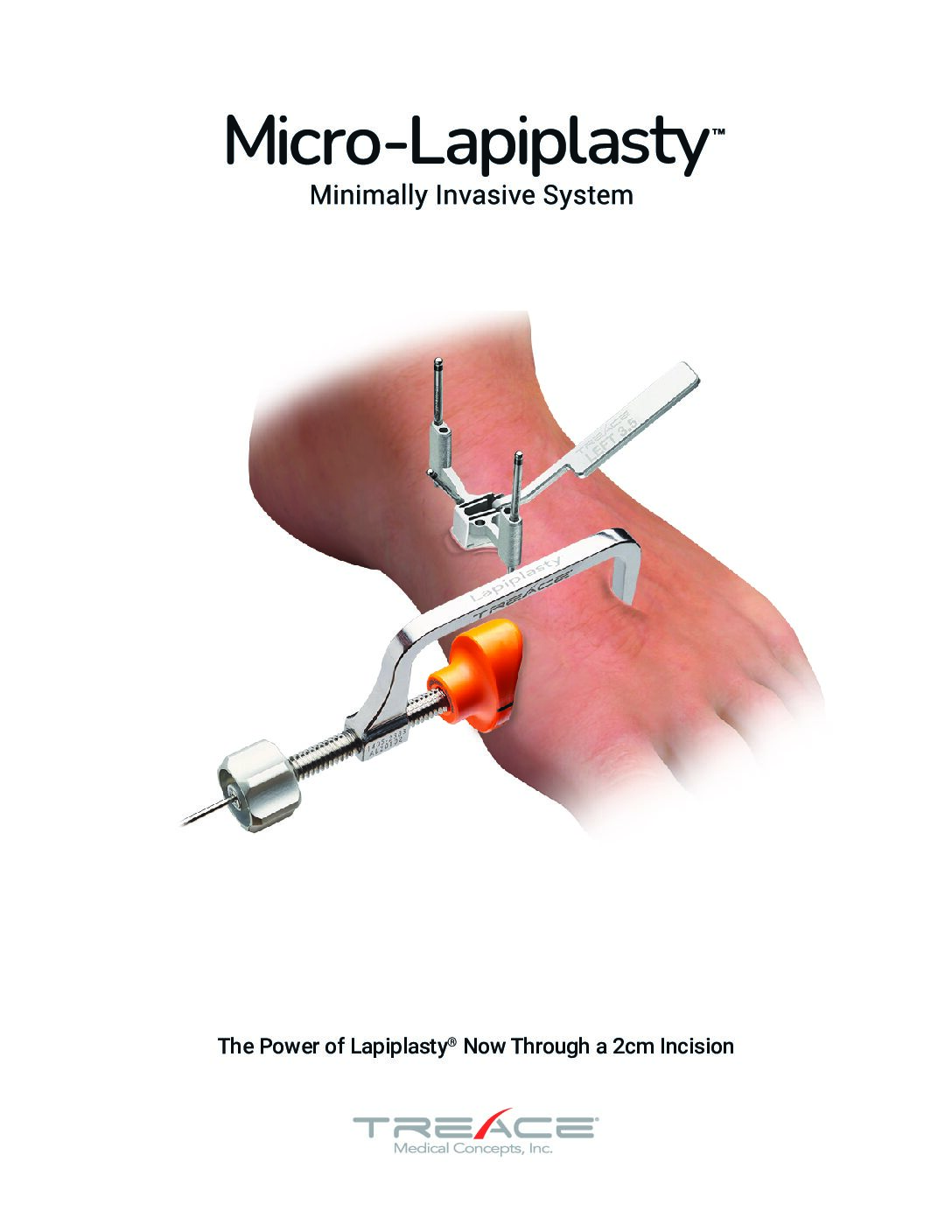 Micro-Lapiplasty™ Brochure