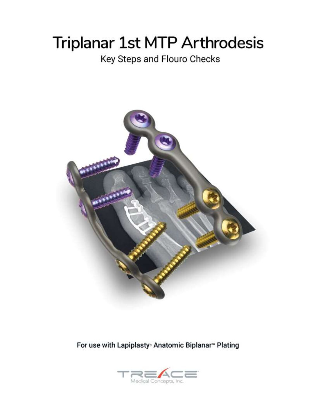 Key Steps and Fluoro Checks