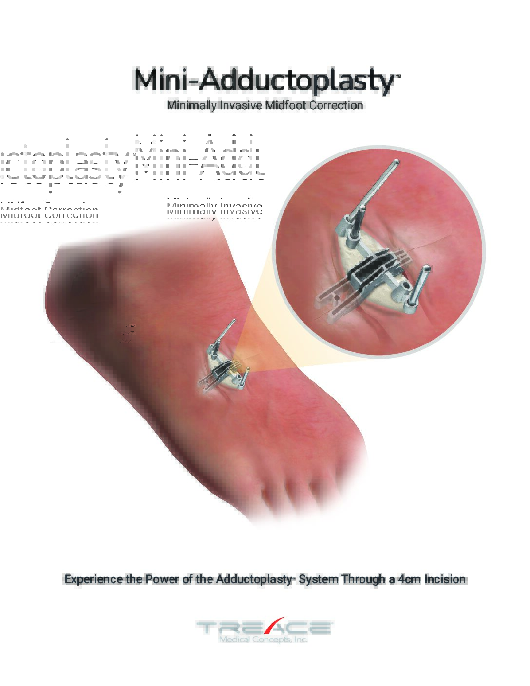Mini-Adductoplasty™ Sales Sheet