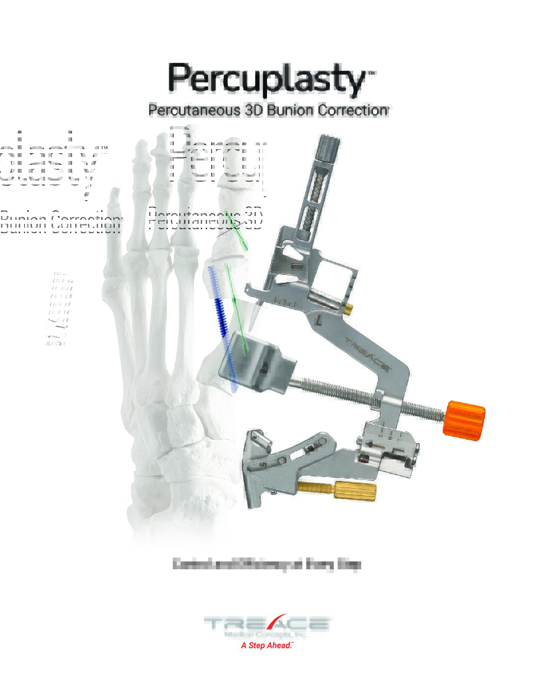 Percuplasty™ Overview