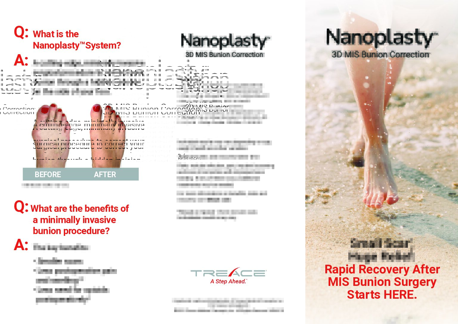 Nanoplasty® Patient Brochure